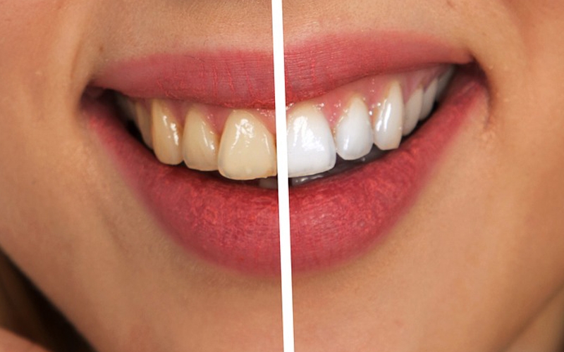 Cómo prevenir el color amarillento de los dientes