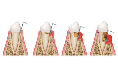 PERIODONCIA