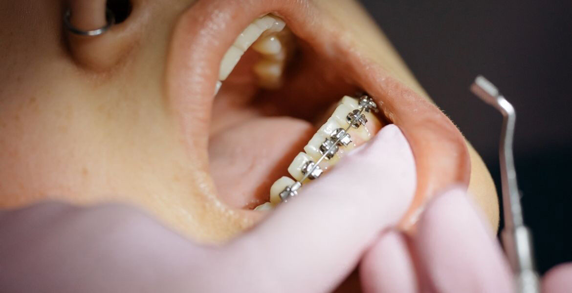 El uso de mascarillas aumenta la demanda de tratamientos de ortodoncia