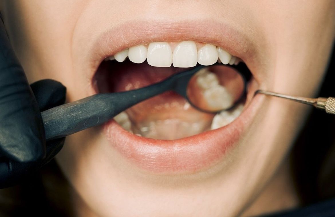 ¿Cómo eliminar el sarro de tus dientes?