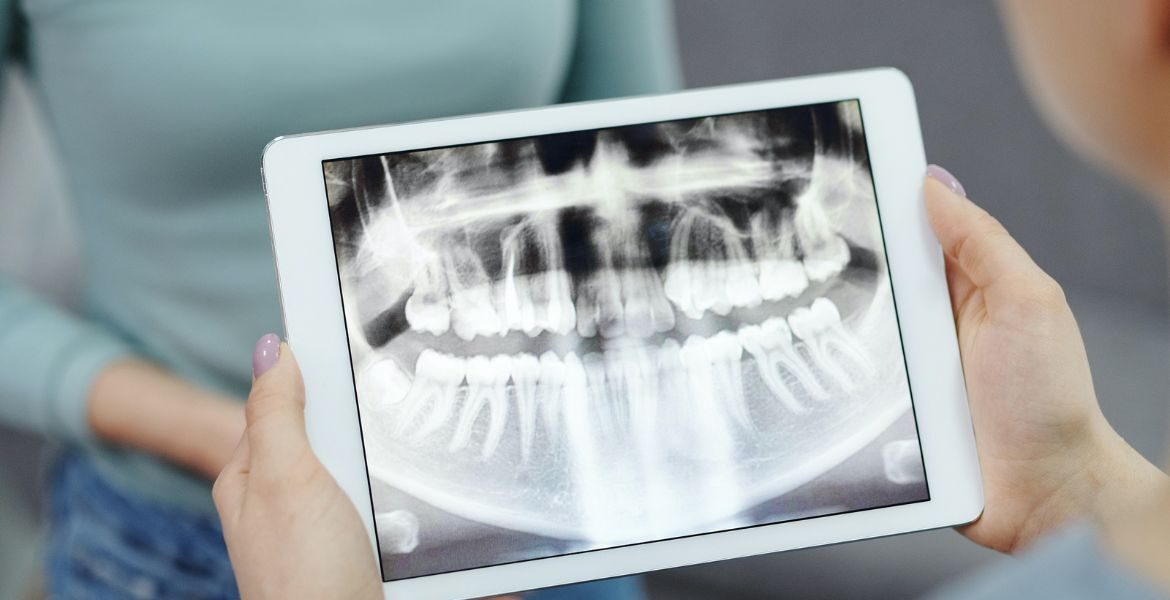 Todas las ventajas de iniciar tu tratamiento de ortodoncia invisible en Clínica Dental Simón