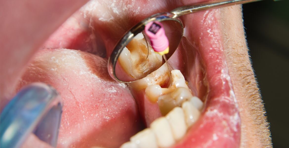 Garantiza una recuperación exitosa después de una endodoncia con estos cuidados esenciales