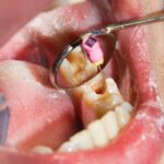 Garantiza una recuperación exitosa después de una endodoncia con estos cuidados esenciales