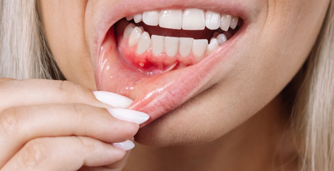 Señales de alerta en tus encías y tu salud dental