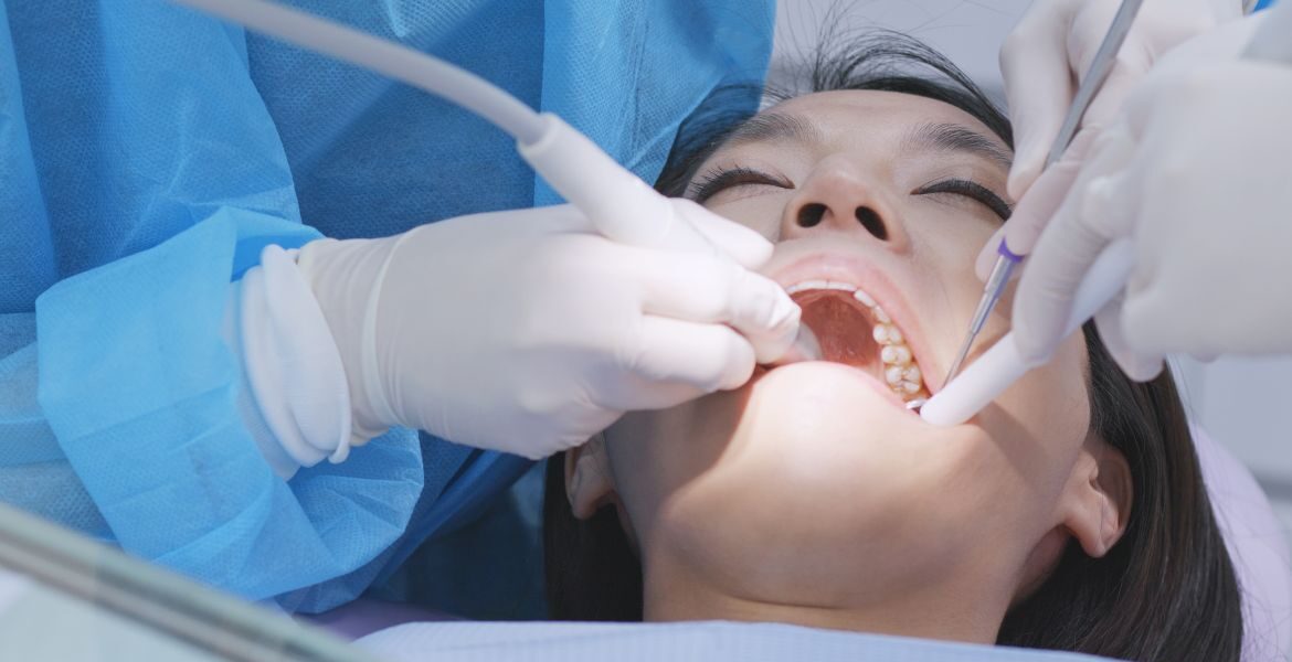 Todo lo que necesitas saber sobre la tartrectomía dental