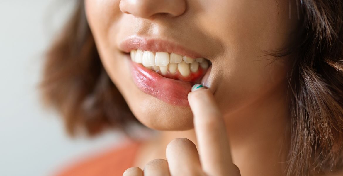 El verano incrementa el riesgo de sufrir caries y gingivitis
