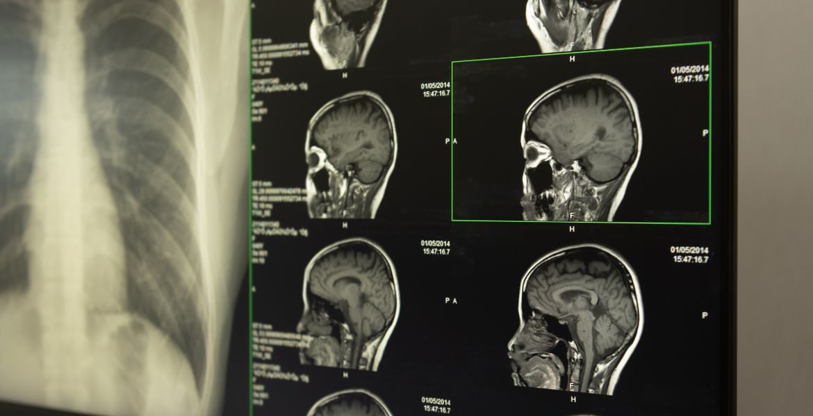 El secreto para mantener tu memoria en forma empieza en tus encías